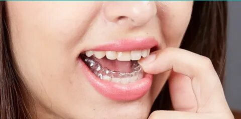 Clear Teeth Aligners Are Now the Doorbell Dental Care and Orthodontics